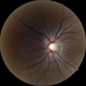 Glaucomatous Optic Atrophy Glaucomatous Optic Atrophy