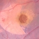 ILM Peeling in a Case of Macular Hole ILM Peeling in a Case of Macular Hole