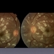 Retinal Vasculopathy With Retinal Vasculitis and Ischemia Retinal Vasculopathy With Retinal Vasculitis and Ischemia