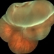 Retinal detachment with Rupture Giant Retinal detachment with Rupture Giant