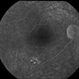 Retinal Cavernous Hemangioma