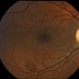Retinal Cavernous Hemangioma