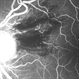 BRVO, FA, Hemorrhage, Diabetic