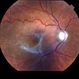 ERM with Retinal Striae ERM with Retinal Striae