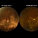 Before and After Vitrectomy Before and After Vitrectomy