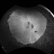 Alagille Syndrome UWF Autofluorescence Alagille Syndrome UWF Autofluorescence