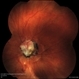 Retinal - Macular Coloboma