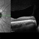 Horizontal OCT Scan Through Right Optic Pit Horizontal OCT Scan Through Right Optic Pit