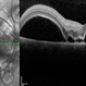Preeclampsia in a 30-Year-Old  - OCT - RE Preeclampsia in a 30-Year-Old  - OCT - RE