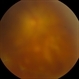 Sympathetic Ophthalmia