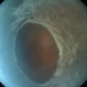Retinoschisis Retinoschisis
