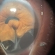 Traumatic iridodialysis