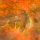 Retinoschisis with Retinal detachment Retinoschisis with Retinal detachment
