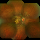 Angioid Streaks with Macular Fibrosis Secondary to Inactive CNV Angioid Streaks with Macular Fibrosis Secondary to Inactive CNV