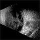 Retinopathy of Prematurity