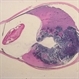 Retinoblastoma Retinoblastoma