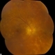 Sympathetic Ophthalmia