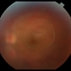 Congenital Vitreous Cyst Congenital Vitreous Cyst