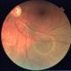 Retinoschisis Retinoschisis