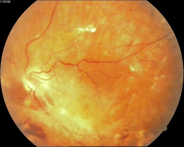 Severe Proliferative Diabetic Retinopathy Retina Image Bank