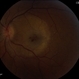 Syphilitic Maculopathy