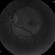 Syphilitic Maculopathy