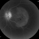 Syphilitic Maculopathy