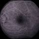 Adult Onset Foveomacular Vitelliform Dystrophy Adult Onset Foveomacular Vitelliform Dystrophy