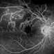 Branch Retinal Vein Occlusion- Fluorescein Angiogram, Montage Branch Retinal Vein Occlusion- Fluorescein Angiogram, Montage
