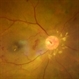 Proliferative Diabetic Retinopathy Proliferative Diabetic Retinopathy