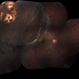 Chronic Retinal Detachment