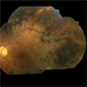 Unilateral Retinitis Pigmentosa Unilateral Retinitis Pigmentosa