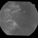 Adult Coats' Disease