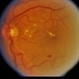 BDR / Macular Edema / Macroaneurysm BDR / Macular Edema / Macroaneurysm
