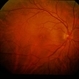 Idiopathic Pre-Retinal Membrane / Vitritis Idiopathic Pre-Retinal Membrane / Vitritis