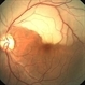 Branch Retinal Artery Occlusion With Calcium Embolus at the Disc - Fundus  Photo Branch Retinal Artery Occlusion With Calcium Embolus at the Disc - Fundus  Photo