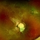 Morning Glory Anomaly With Retinal Detachment Managed With Amniotic Membrane Graft Morning Glory Anomaly With Retinal Detachment Managed With Amniotic Membrane Graft