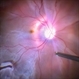 Retinal Detachment with Tear Retinal Detachment with Tear