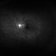Ocular Ischemic Syndrome Ocular Ischemic Syndrome