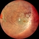 Macular Schisis with RD Macular Schisis with RD