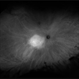 Choroidal Hemangioma Choroidal Hemangioma