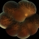 Advanced Retinitis Pigmentosa Advanced Retinitis Pigmentosa