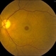 Macular Hole