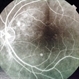 Choroidal Hemangioma
