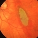 Macular Hemorrhage After Scleral Buckling Macular Hemorrhage After Scleral Buckling