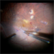 Epiretinal Membrane Peeling during Vitrectomy Surgery | Intra-Operative Still Epiretinal Membrane Peeling during Vitrectomy Surgery | Intra-Operative Still