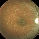 Stargardt's Disease RE Stargardt's Disease RE