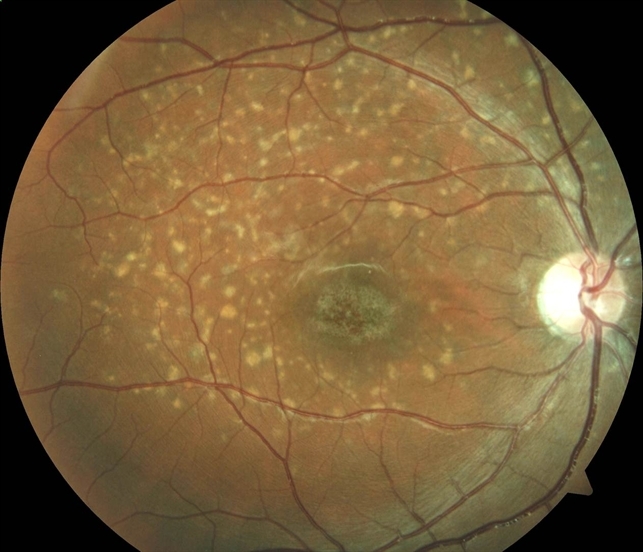 Stargardt's Disease RE Retina Image Bank