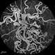 Wyburn Mason Fluorescein Angiography