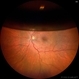 Intraocular Gas Bubble - Wide-field True Color CSLO Intraocular Gas Bubble - Wide-field True Color CSLO